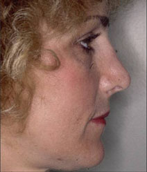 Rhinoplasty Before and After Photos | Dr. Balakhani