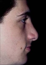 Rhinoplasty
