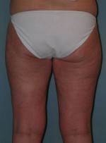 Thigh Lift