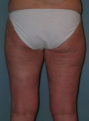 Thigh Lift Before and After Photos