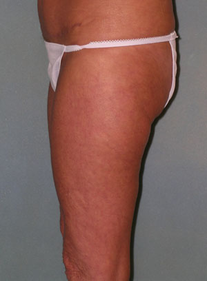 Thigh Lift Before and After Photos