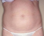 Body Liposculpture