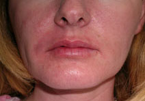 Dermal Fillers Before and After Photos