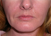 Chin Augmentation Before and After Photos