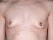 Augmentation Mammoplasty Case 3496 Before Photo Augmentation Mammoplasty