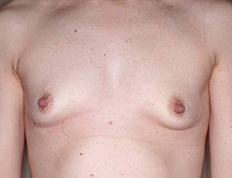 Augmentation Mammoplasty Before and After Photos