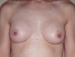 Augmentation Mammoplasty