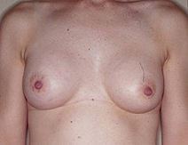 Augmentation Mammoplasty Case 3496 After Photo Augmentation Mammoplasty