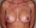 Augmentation Mammoplasty