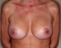 Augmentation Mammoplasty Case 3502 After Photo Augmentation Mammoplasty