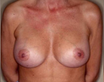 Augmentation Mammoplasty Before and After Photos