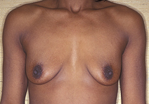 Augmentation Mammoplasty Case 3507 Before Photo Augmentation Mammoplasty