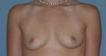 Augmentation Mammoplasty Case 3512 Before Photo Augmentation Mammoplasty
