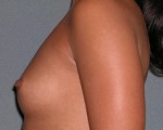 Augmentation Mammoplasty