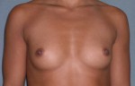 Augmentation Mammoplasty