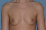 Augmentation Mammoplasty