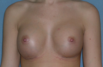 Augmentation Mammoplasty Before and After Photos