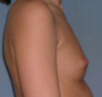 Augmentation Mammoplasty