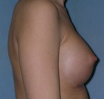 Augmentation Mammoplasty