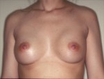 Augmentation Mammoplasty