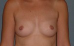 Augmentation Mammoplasty