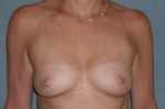 Augmentation Mammoplasty