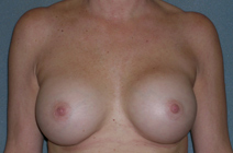 Augmentation Mammoplasty Before and After Photos