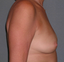 Augmentation Mammoplasty Before and After Photos