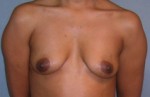 Augmentation Mammoplasty