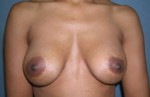 Augmentation Mammoplasty