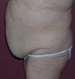 Belt Lipectomy