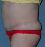 Belt Lipectomy