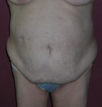 Belt Lipectomy