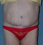 Belt Lipectomy