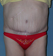 Belt Lipectomy Case 3586 After Photo Belt Lipectomy