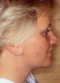 Facelift Before and After Photos