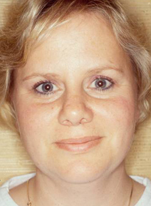 Facelift Before and After Photos