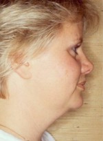 Facelift