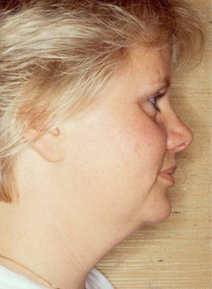 Facelift Before and After Photos