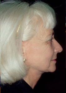 Facelift Before and After Photos