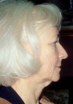 Facelift