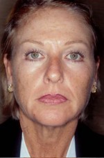 Facelift