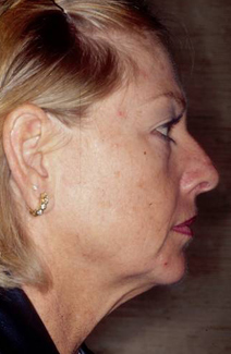 Facelift Before and After Photos