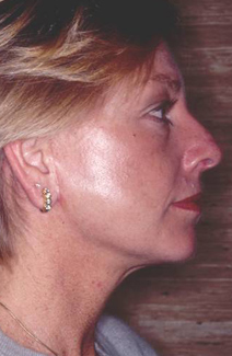 Facelift Before and After Photos