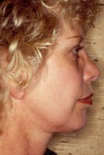 Facelift