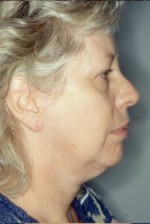 Facelift