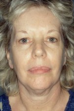 Facelift
