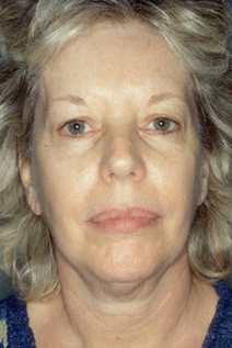 Facelift Before and After Photos