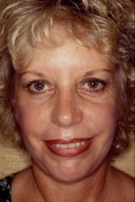 Facelift