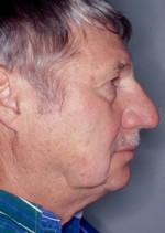 Facelift